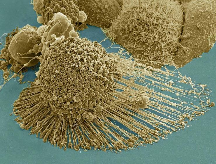 A dying cancer cell with filopodia stretched out to its right. The protrusions help cancer migrate. Stock NIH NCMIR image. The image does not display a cell treated in the Georgia Tech study. Credit: NIH-funded image of HeLa cell / National Center for Mic
